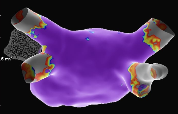 Reconstrução tridimensional do átrio esquerdo e das veias pulmonares antes da ablação.