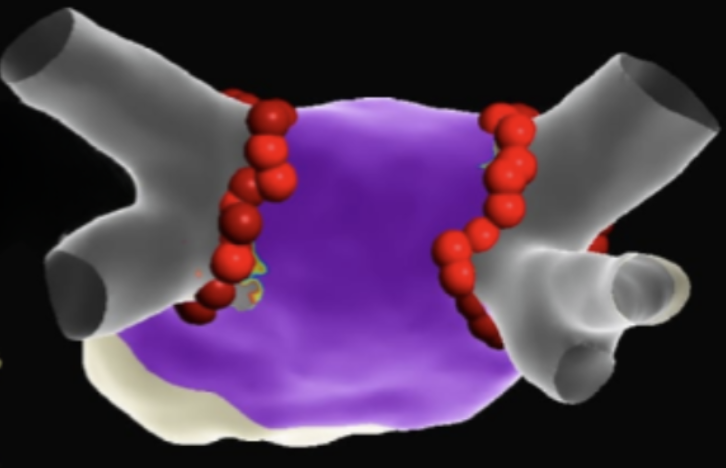 Reconstrução tridimensional do átrio esquerdo após a ablação, com marcadores visíveis próximos às veias pulmonares.